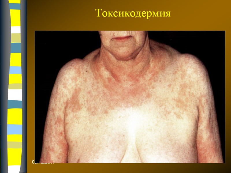 09.12.2017 Токсикодермия